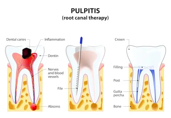 Root Canal Pleasant Hill | Dentist in Pleasant Hill